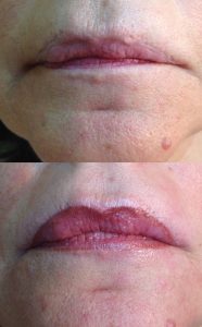 visage avec dermopigmentation des lèvres